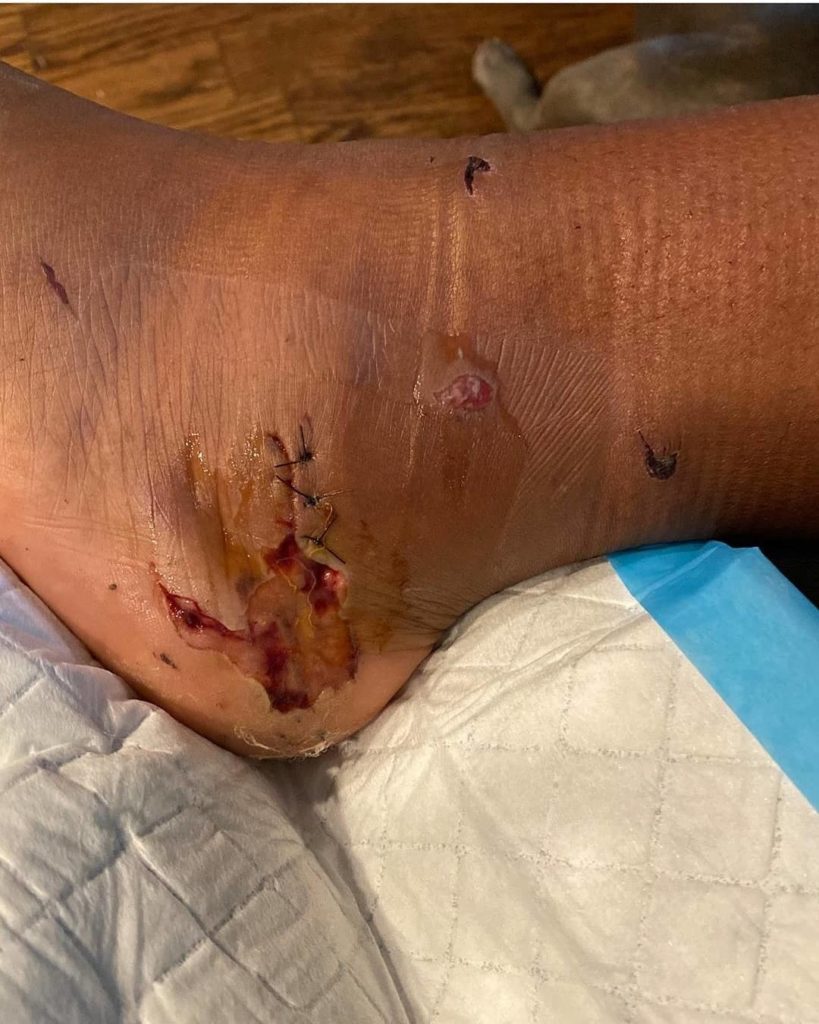 megan stallion gunshot wound 3